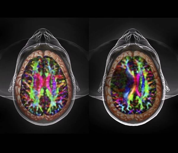 Brain cancer, DTI and 3D CT scans C016  /  6414