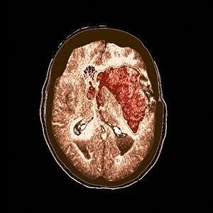 Brain haemorrhage, MRI scan F008 / 3468