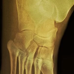 Gouty foot, X-ray