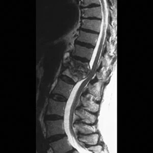 Tuberculosis of the spine, MRI scan