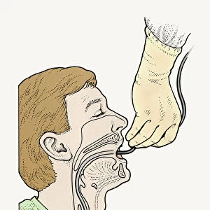 Diagram showing bronchoscope being inserted into patients throat